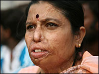 Woman with acid burns, close-up