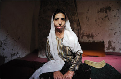 Zahra, 21, tried to commit suicide by self-immolation six years ago because she objected to her arranged marriage.