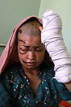 An Afghan woman who was allegedly burnt, receives medical treatment at a local hospital  EPA photo /Jalil Rezayee